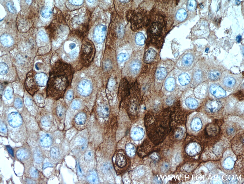 Immunohistochemistry (IHC) staining of human breast cancer tissue using GCDFP-15/PIP Polyclonal antibody (16068-1-AP)