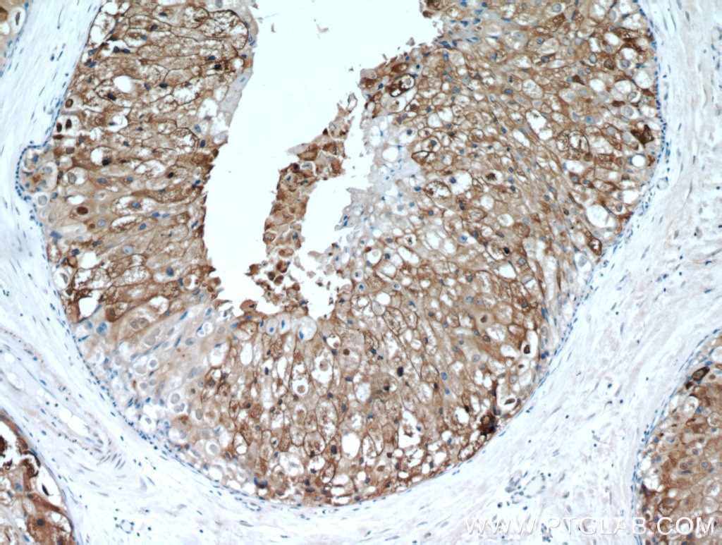 Immunohistochemistry (IHC) staining of human breast cancer tissue using GCDFP-15/PIP Polyclonal antibody (16068-1-AP)