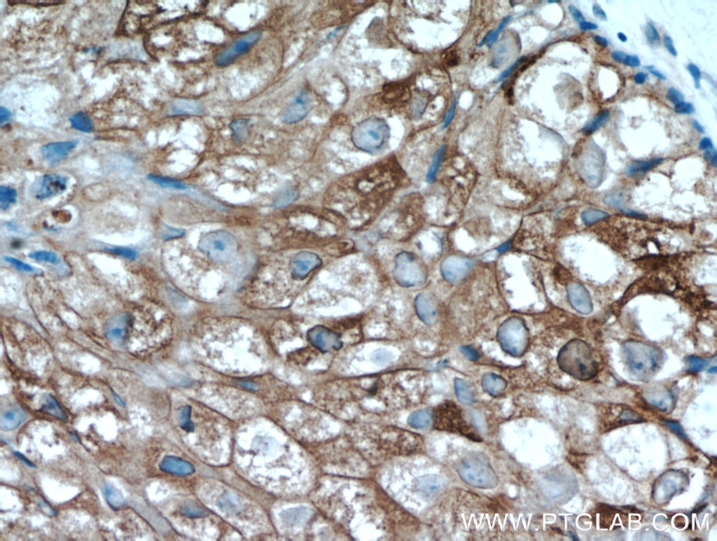 Immunohistochemistry (IHC) staining of human breast cancer tissue using GCDFP-15/PIP Polyclonal antibody (16068-1-AP)