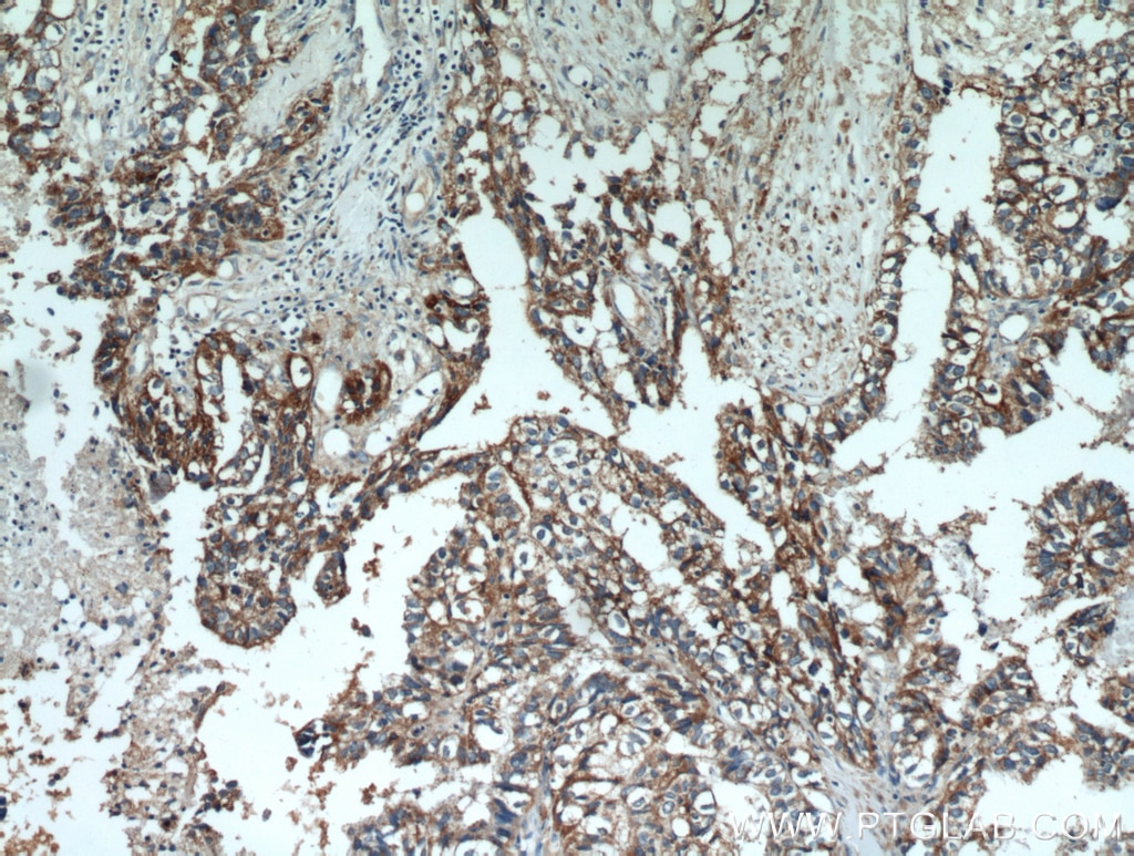 Immunohistochemistry (IHC) staining of human breast cancer tissue using GCDFP-15/PIP Polyclonal antibody (16068-1-AP)