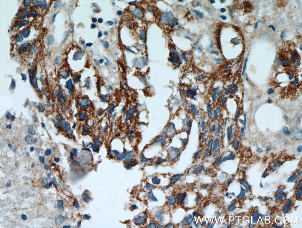 IHC staining of human breast cancer using 16068-1-AP