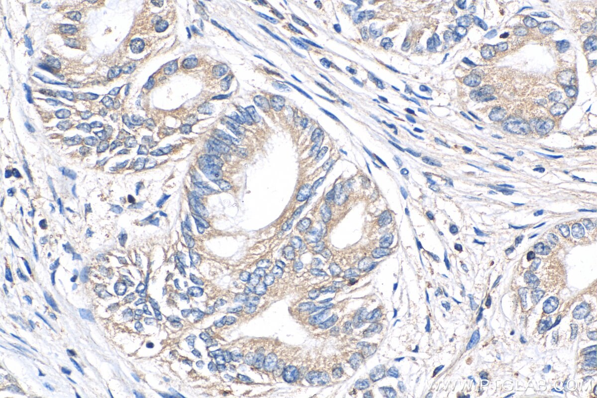 Immunohistochemistry (IHC) staining of human pancreas cancer tissue using PIP4K2B Polyclonal antibody (13218-1-AP)