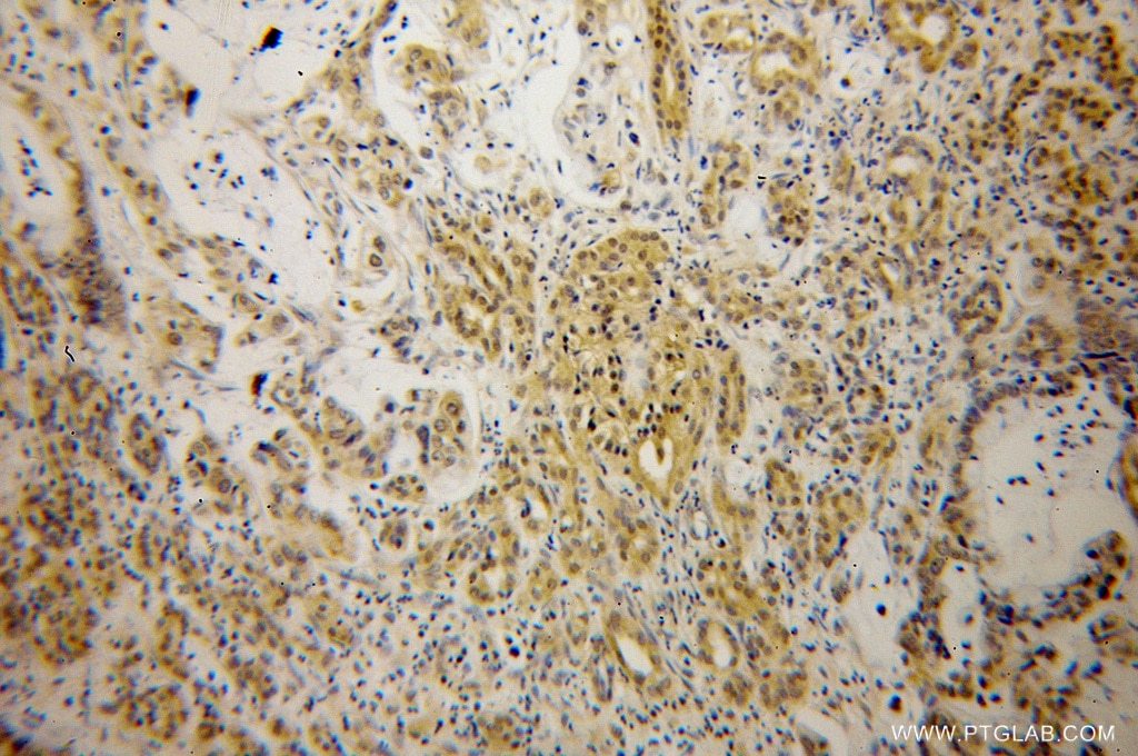 Immunohistochemistry (IHC) staining of human pancreas cancer tissue using PIP4K2B Polyclonal antibody (13218-1-AP)