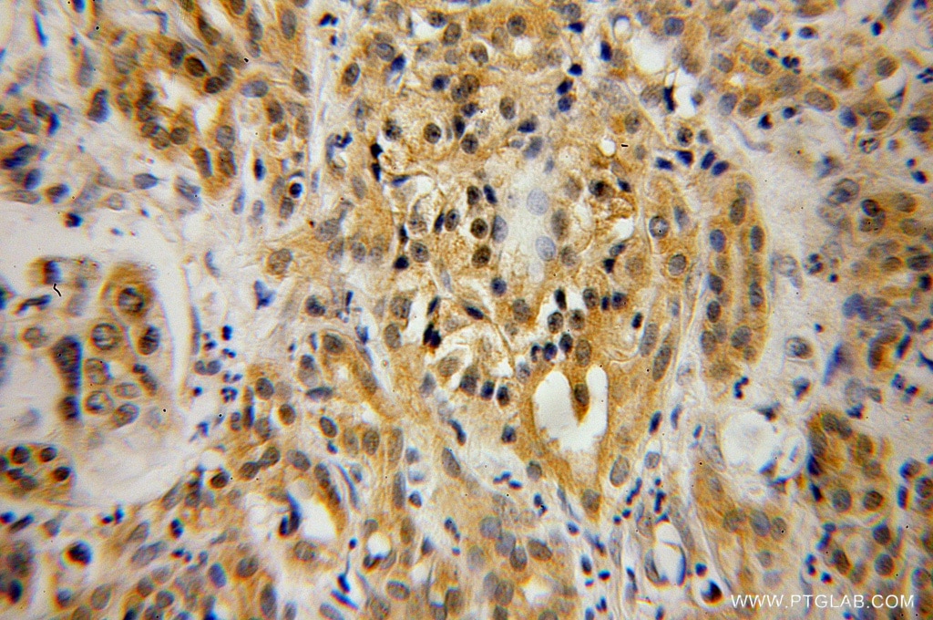 Immunohistochemistry (IHC) staining of human pancreas cancer tissue using PIP4K2B Polyclonal antibody (13218-1-AP)