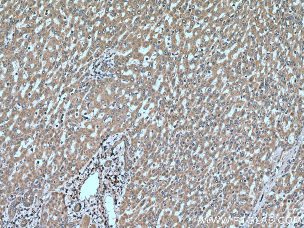 Immunohistochemistry (IHC) staining of human liver cancer tissue using PIP4K2C Polyclonal antibody (17077-1-AP)