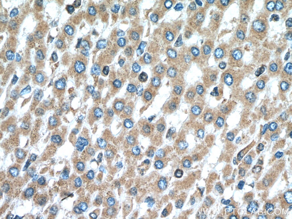 Immunohistochemistry (IHC) staining of human liver cancer tissue using PIP4K2C Polyclonal antibody (17077-1-AP)
