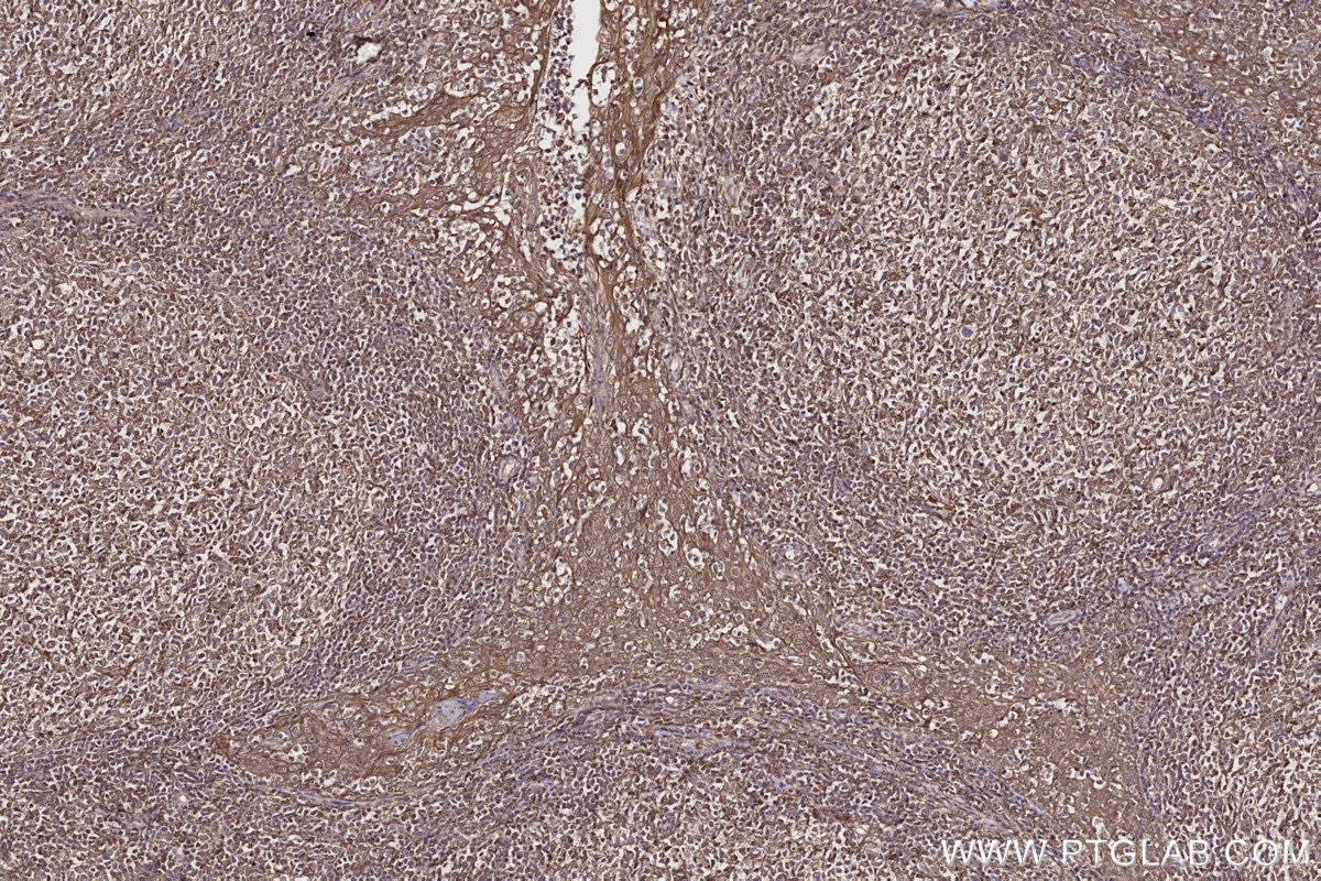 Immunohistochemistry (IHC) staining of human tonsillitis tissue using PIP4K2C Polyclonal antibody (17077-1-AP)