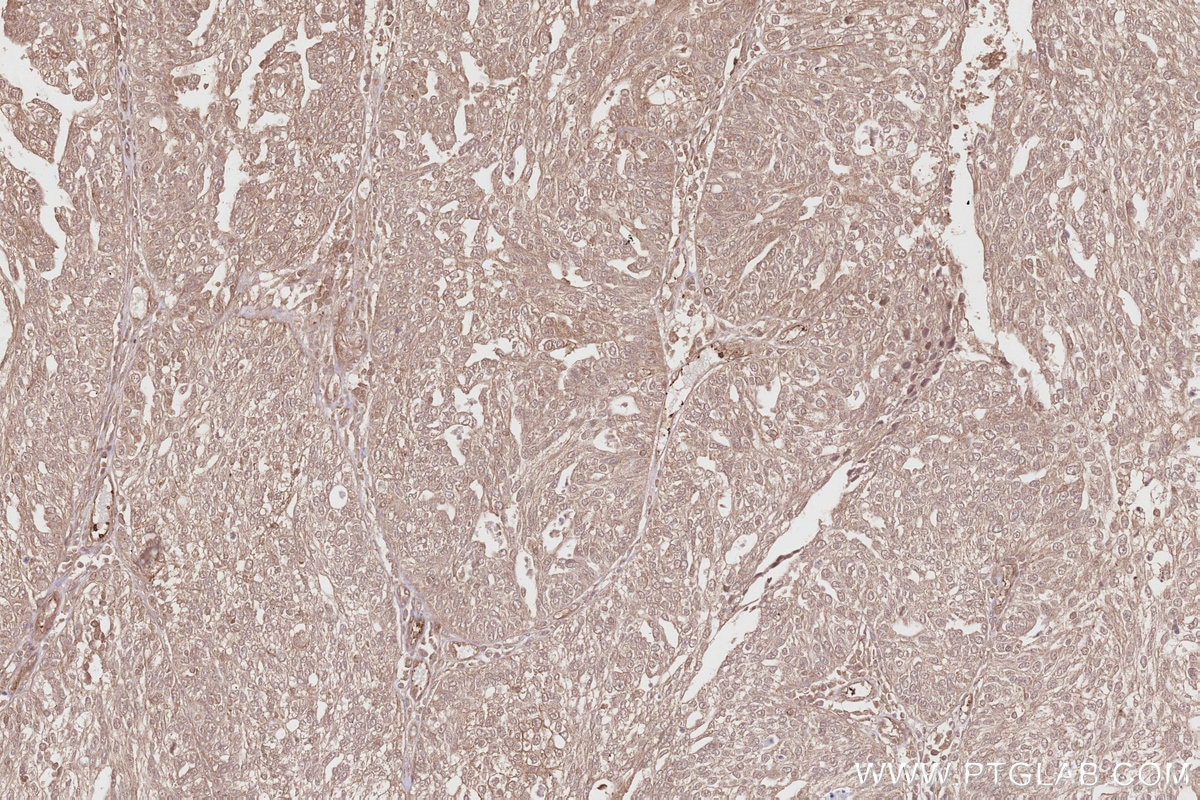 Immunohistochemistry (IHC) staining of human ovary cancer tissue using PIP5K1A Polyclonal antibody (15713-1-AP)