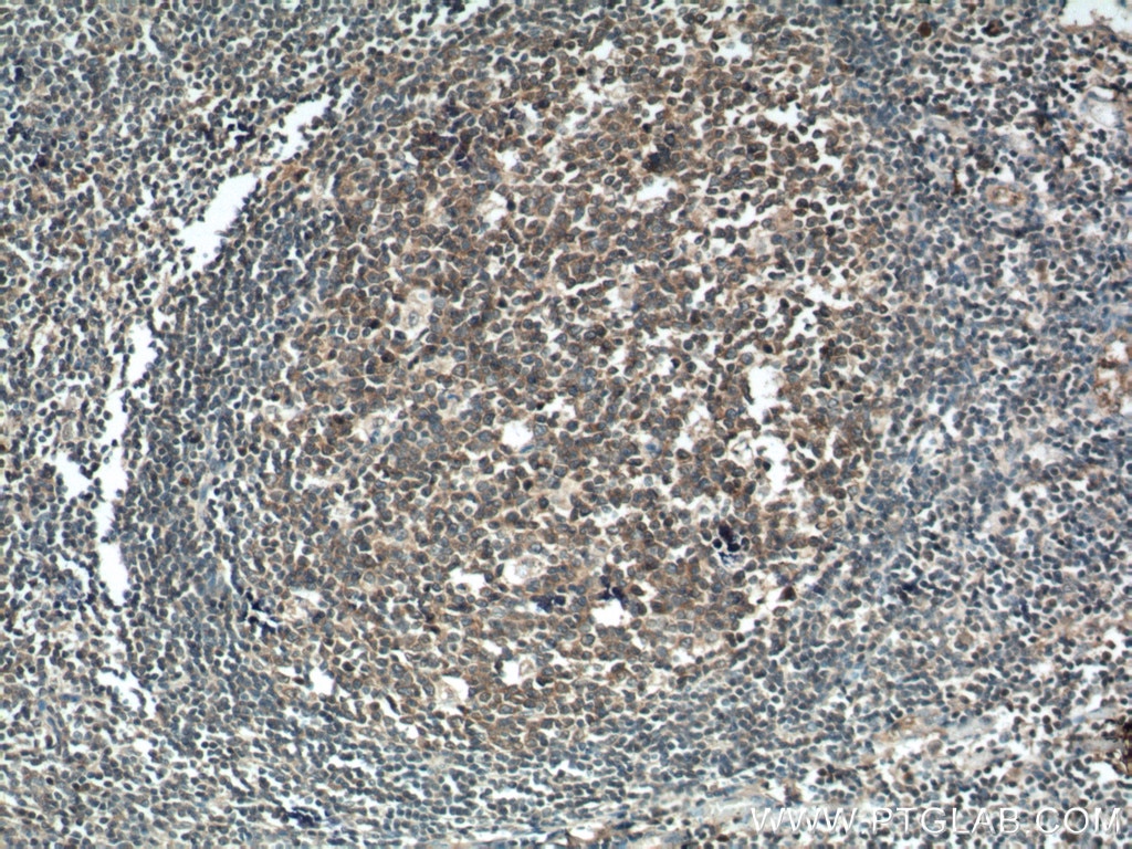 Immunohistochemistry (IHC) staining of human tonsillitis tissue using PIP5K1A Polyclonal antibody (15713-1-AP)