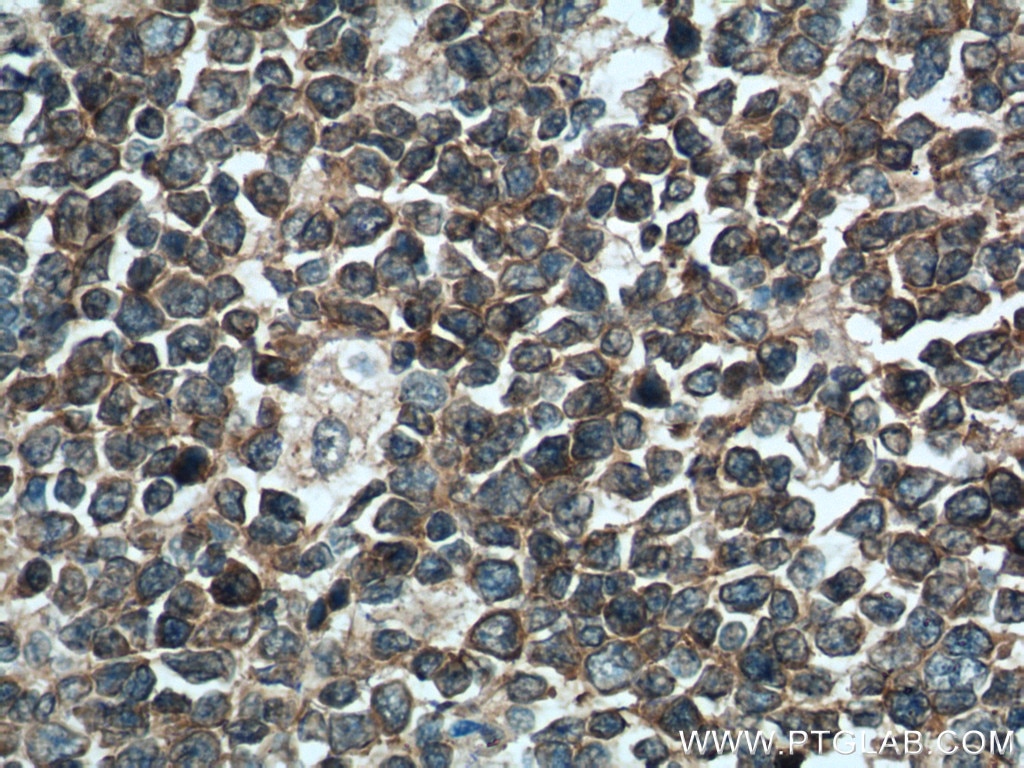 Immunohistochemistry (IHC) staining of human tonsillitis tissue using PIP5K1A Polyclonal antibody (15713-1-AP)