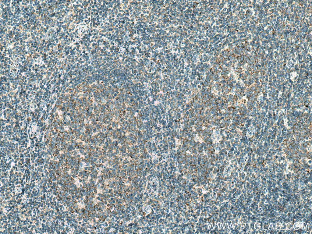 Immunohistochemistry (IHC) staining of human tonsillitis tissue using PIP5K1A Monoclonal antibody (67483-1-Ig)