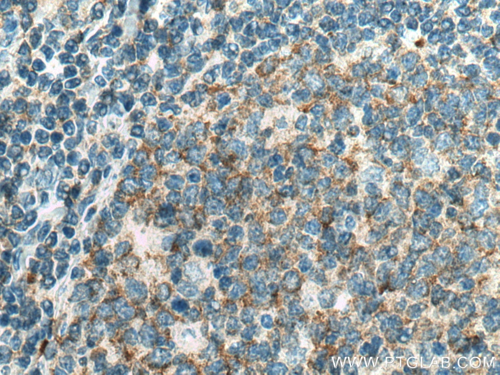 Immunohistochemistry (IHC) staining of human tonsillitis tissue using PIP5K1A Monoclonal antibody (67483-1-Ig)