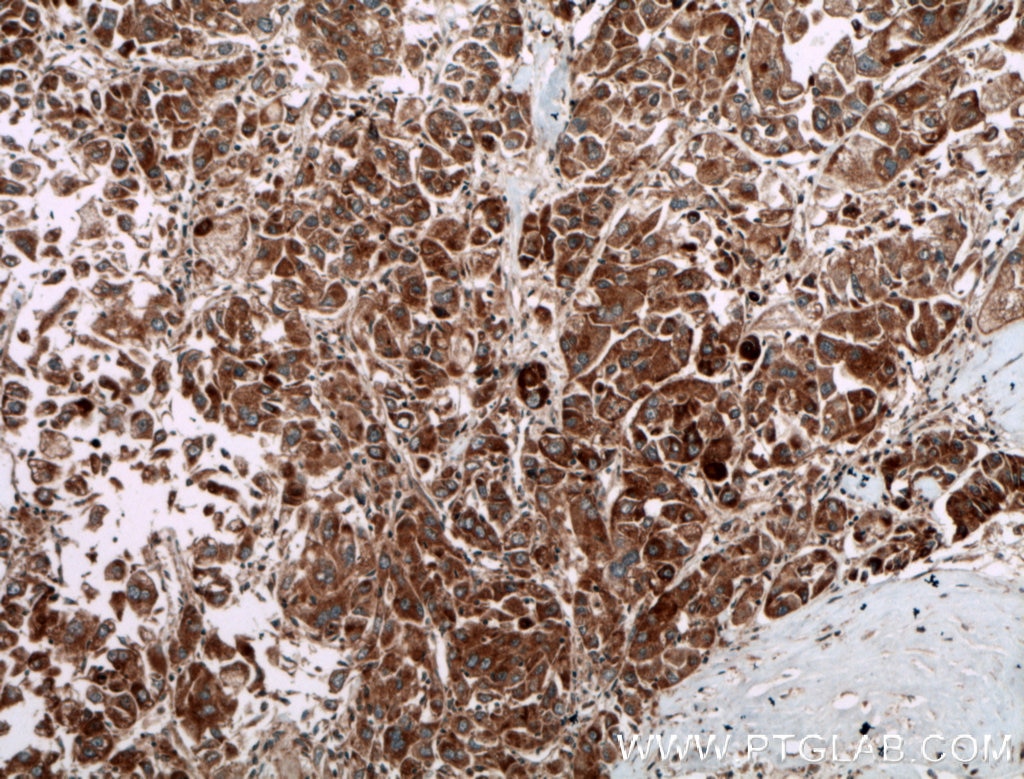 Immunohistochemistry (IHC) staining of human liver cancer tissue using PIP5K1C Polyclonal antibody (27640-1-AP)