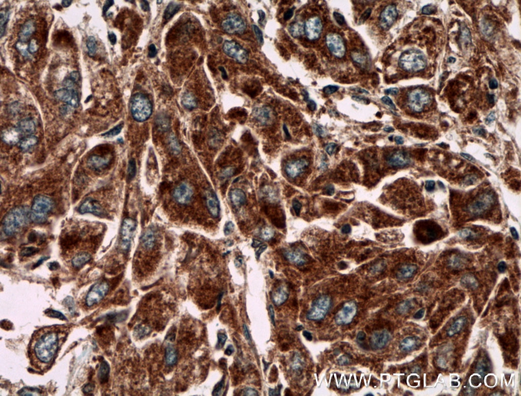 Immunohistochemistry (IHC) staining of human liver cancer tissue using PIP5K1C Polyclonal antibody (27640-1-AP)