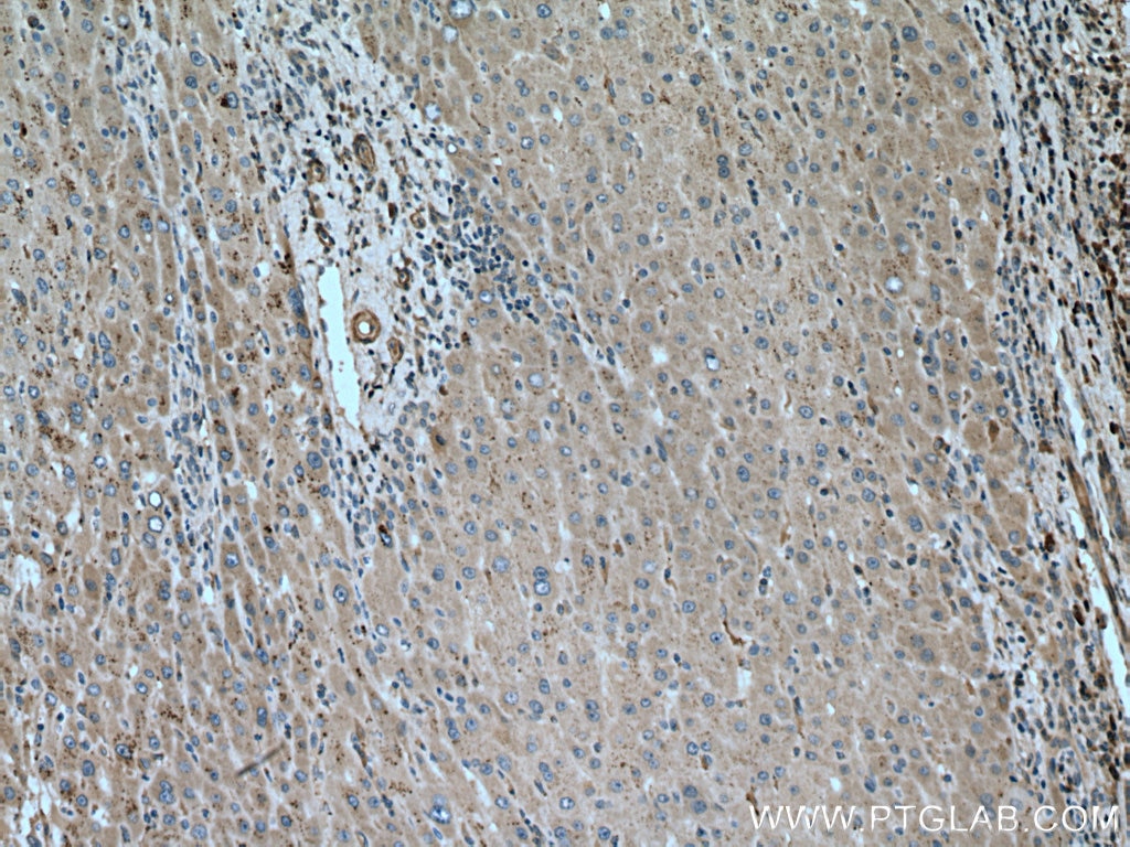 Immunohistochemistry (IHC) staining of human liver cancer tissue using PIP5K3 Polyclonal antibody (13361-1-AP)