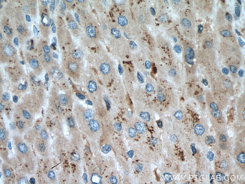 Immunohistochemistry (IHC) staining of human liver cancer tissue using PIP5K3 Polyclonal antibody (13361-1-AP)