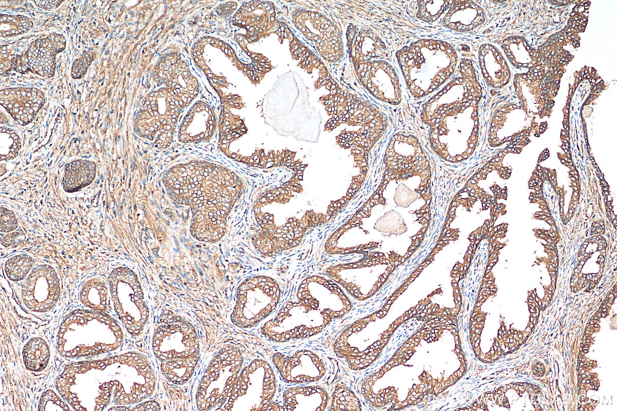 Immunohistochemistry (IHC) staining of human prostate cancer tissue using PITPNB Polyclonal antibody (13110-1-AP)