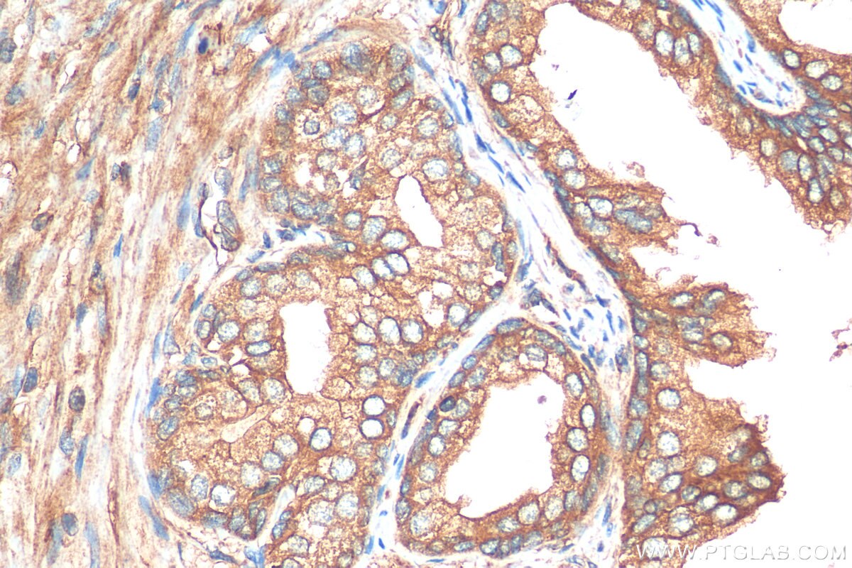 Immunohistochemistry (IHC) staining of human prostate cancer tissue using PITPNB Polyclonal antibody (13110-1-AP)