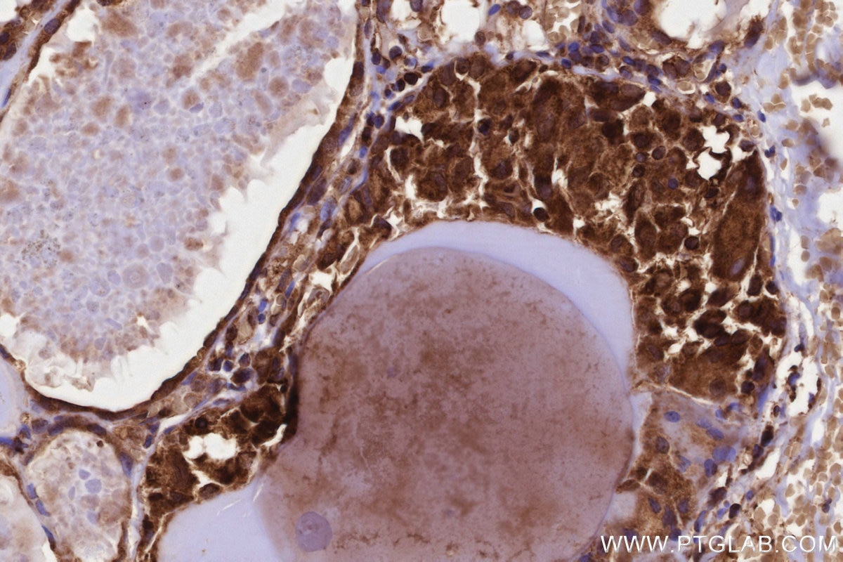 Immunohistochemistry (IHC) staining of human thyroid cancer tissue using PITPNB Polyclonal antibody (13110-1-AP)