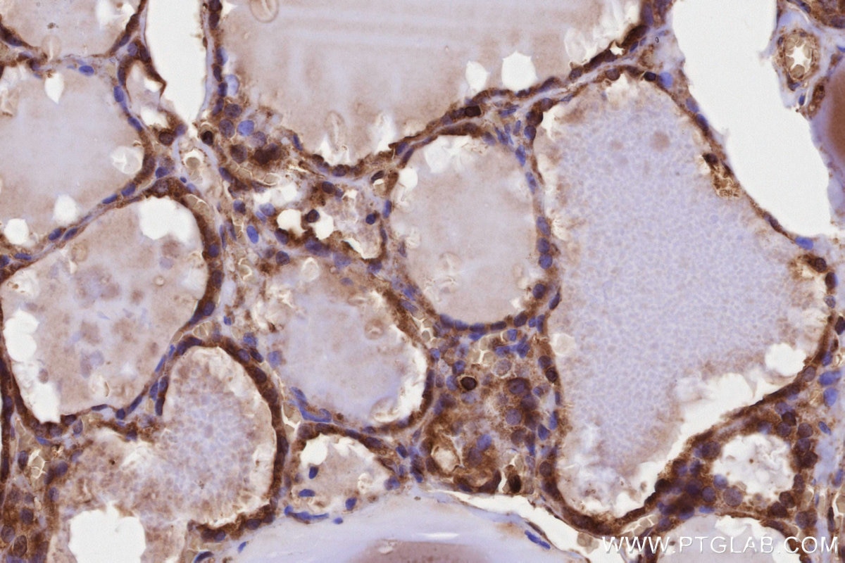 Immunohistochemistry (IHC) staining of human thyroid cancer tissue using PITPNB Polyclonal antibody (13110-1-AP)