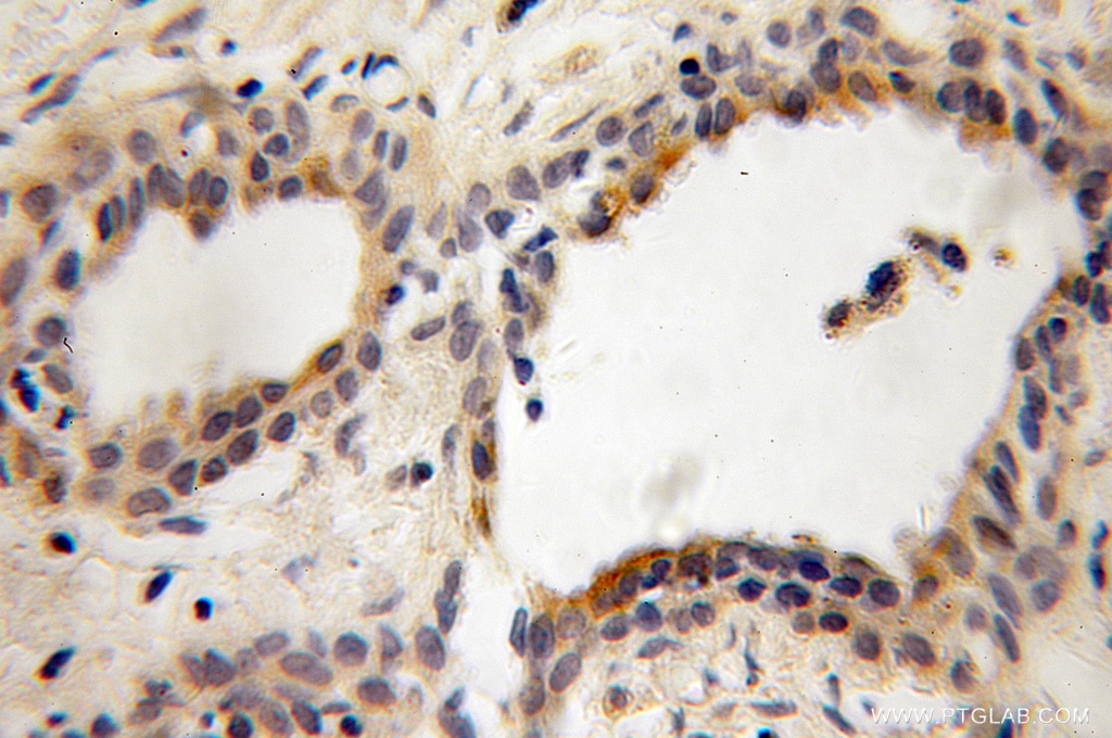 Immunohistochemistry (IHC) staining of human prostate cancer tissue using PITPNB Polyclonal antibody (13110-1-AP)