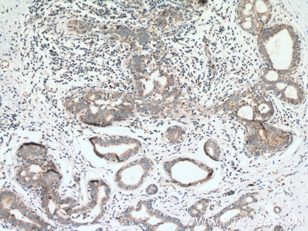 IHC staining of human breast cancer using 10101-2-AP