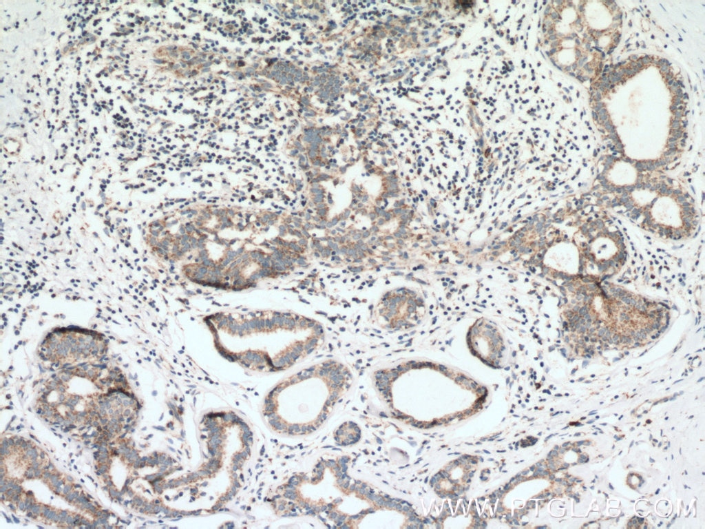 Immunohistochemistry (IHC) staining of human breast cancer tissue using PITRM1 Polyclonal antibody (10101-2-AP)