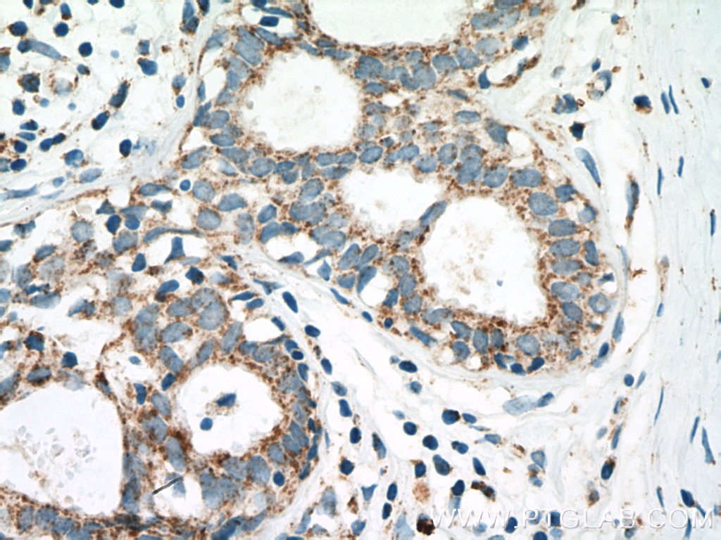 Immunohistochemistry (IHC) staining of human breast cancer tissue using PITRM1 Polyclonal antibody (10101-2-AP)