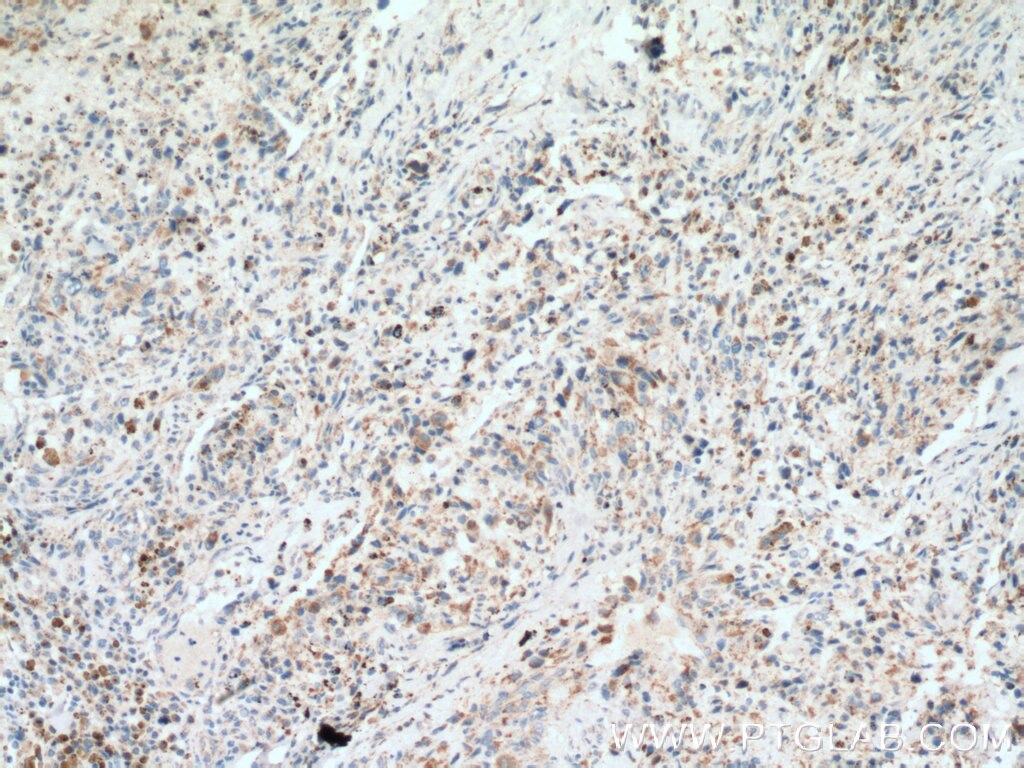 Immunohistochemistry (IHC) staining of human osteosarcoma tissue using PITRM1 Polyclonal antibody (10101-2-AP)