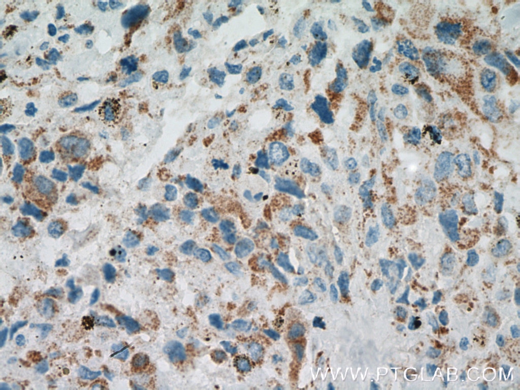 IHC staining of human osteosarcoma using 10101-2-AP