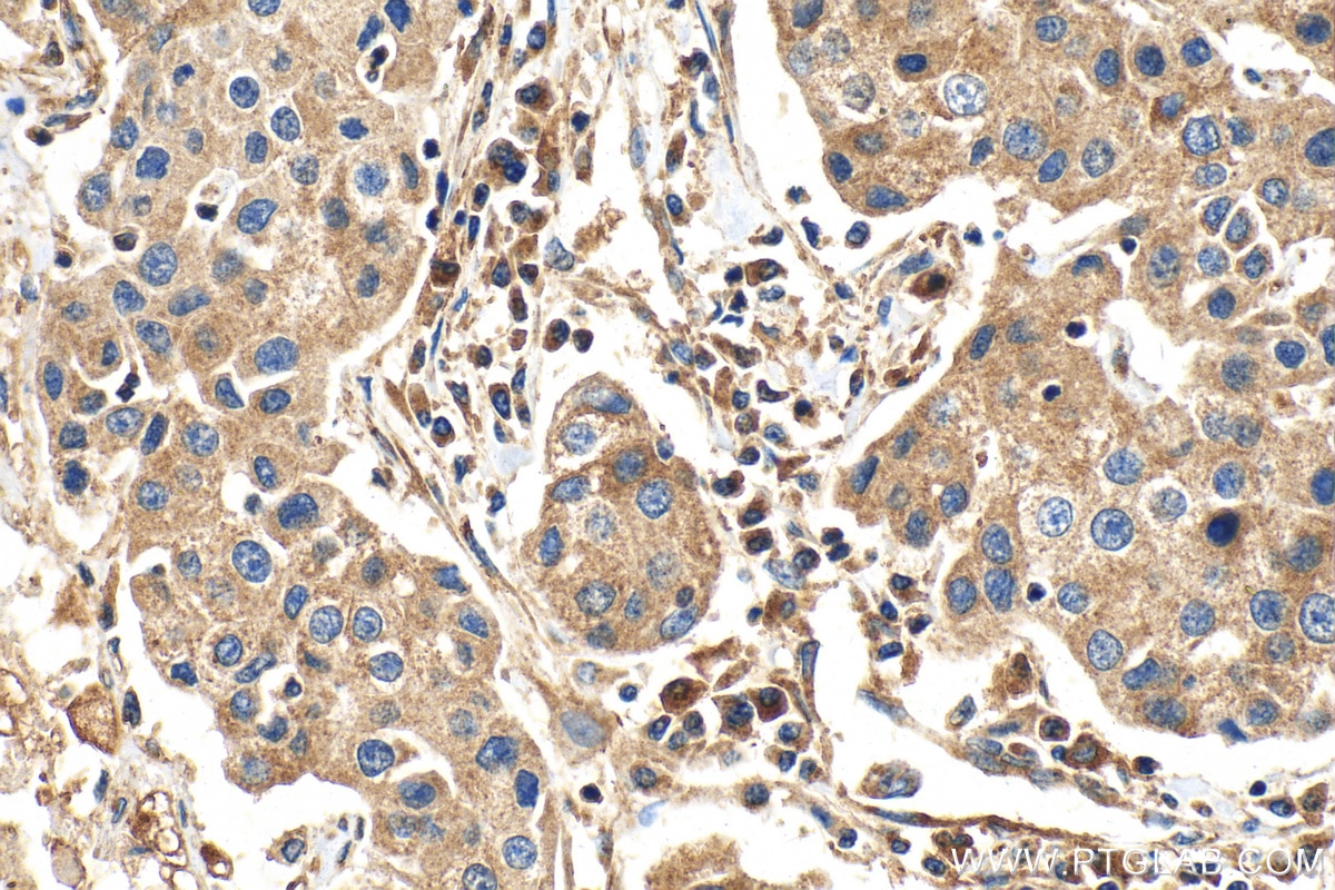 Immunohistochemistry (IHC) staining of human breast cancer tissue using PITRM1 Polyclonal antibody (30674-1-AP)