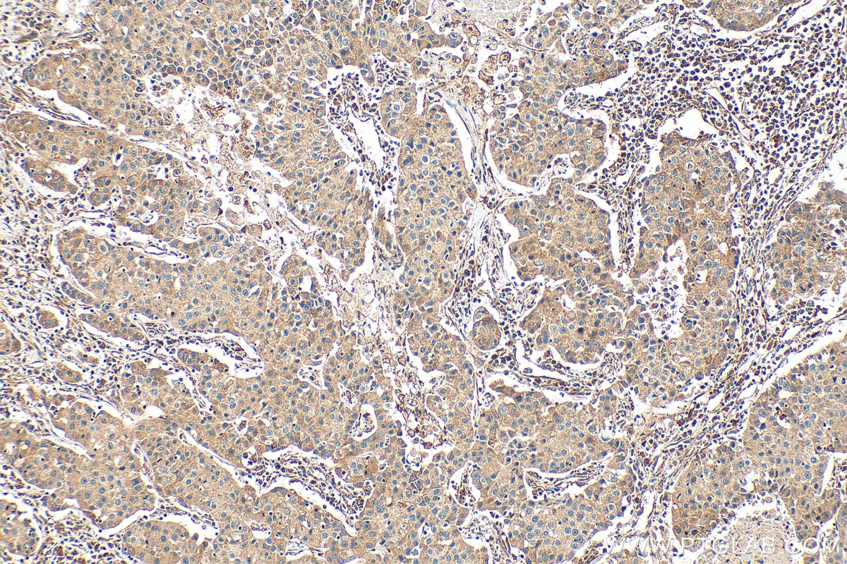 Immunohistochemistry (IHC) staining of human breast cancer tissue using PITRM1 Polyclonal antibody (30674-1-AP)