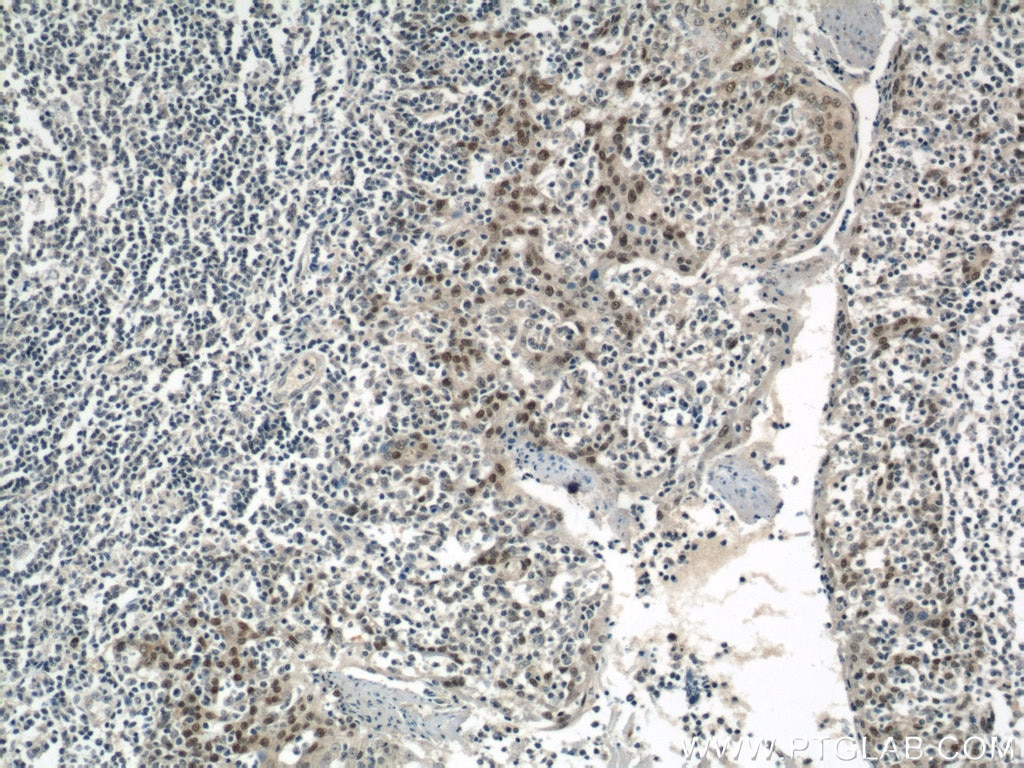 Immunohistochemistry (IHC) staining of human tonsillitis tissue using PITX1 Polyclonal antibody (10873-1-AP)