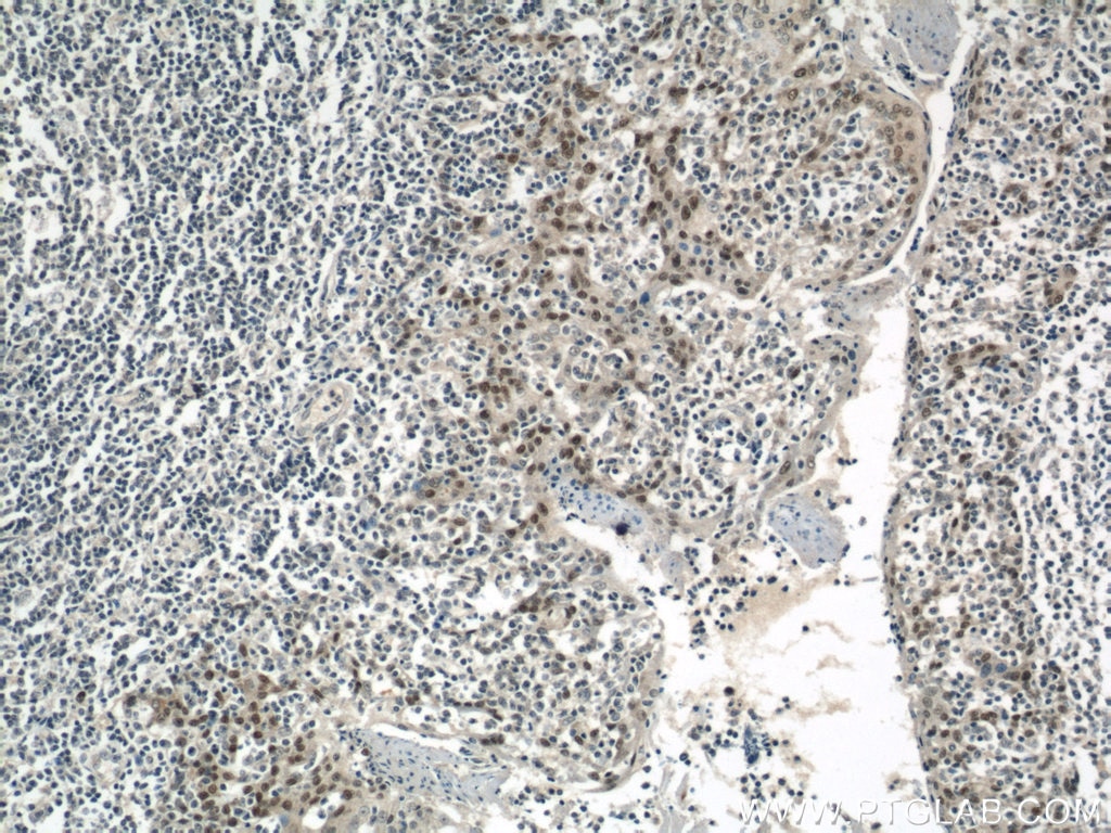 IHC staining of human tonsillitis using 10873-1-AP