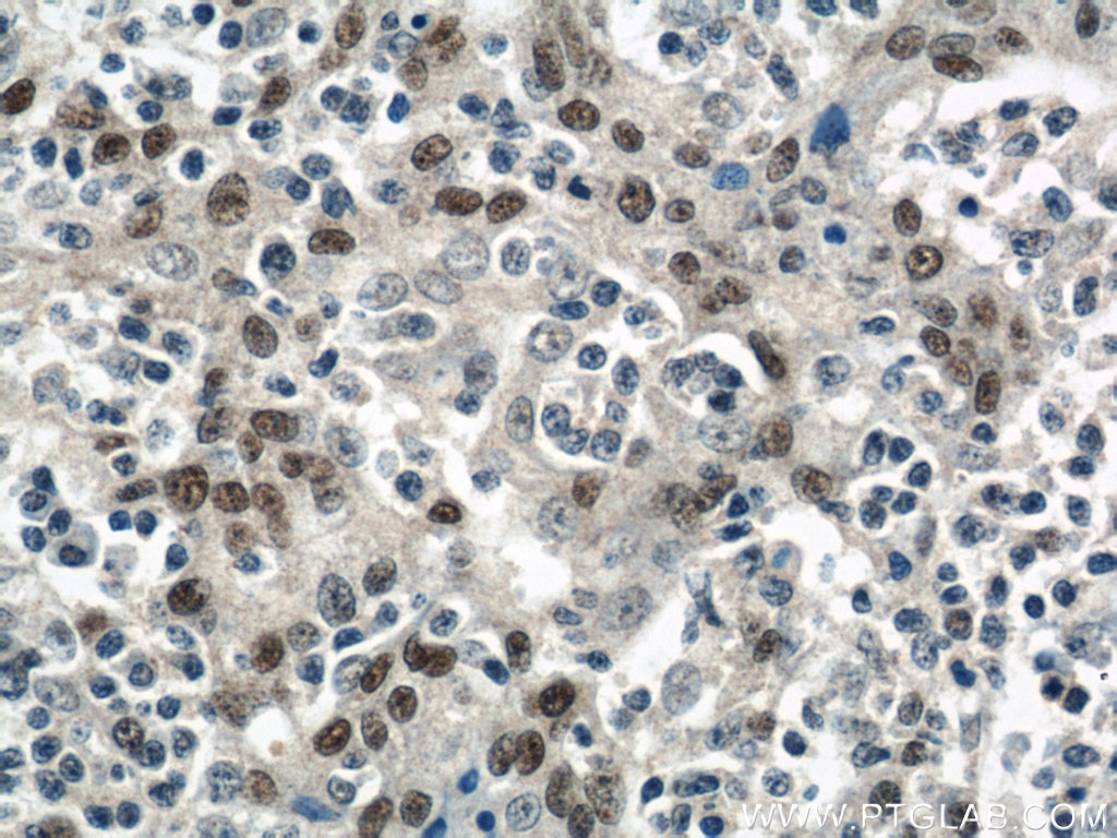 IHC staining of human tonsillitis using 10873-1-AP