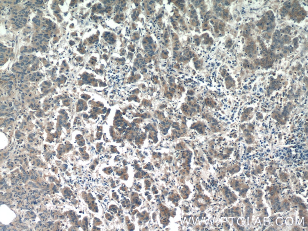 Immunohistochemistry (IHC) staining of human prostate cancer tissue using PIWIL1 Polyclonal antibody (15659-1-AP)