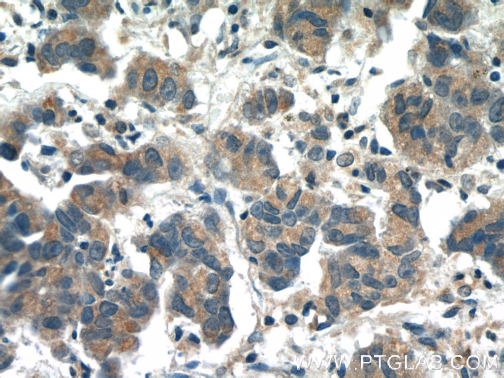 Immunohistochemistry (IHC) staining of human prostate cancer tissue using PIWIL1 Polyclonal antibody (15659-1-AP)