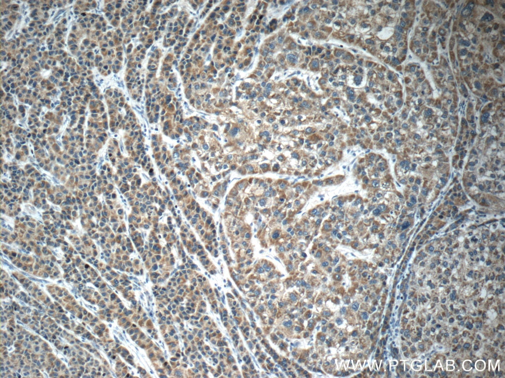Immunohistochemistry (IHC) staining of human liver cancer tissue using PIWIL1 Polyclonal antibody (15659-1-AP)