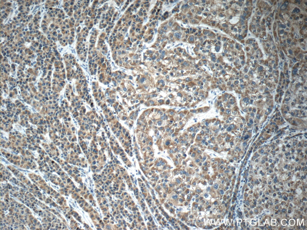 IHC staining of human liver cancer using 15659-1-AP