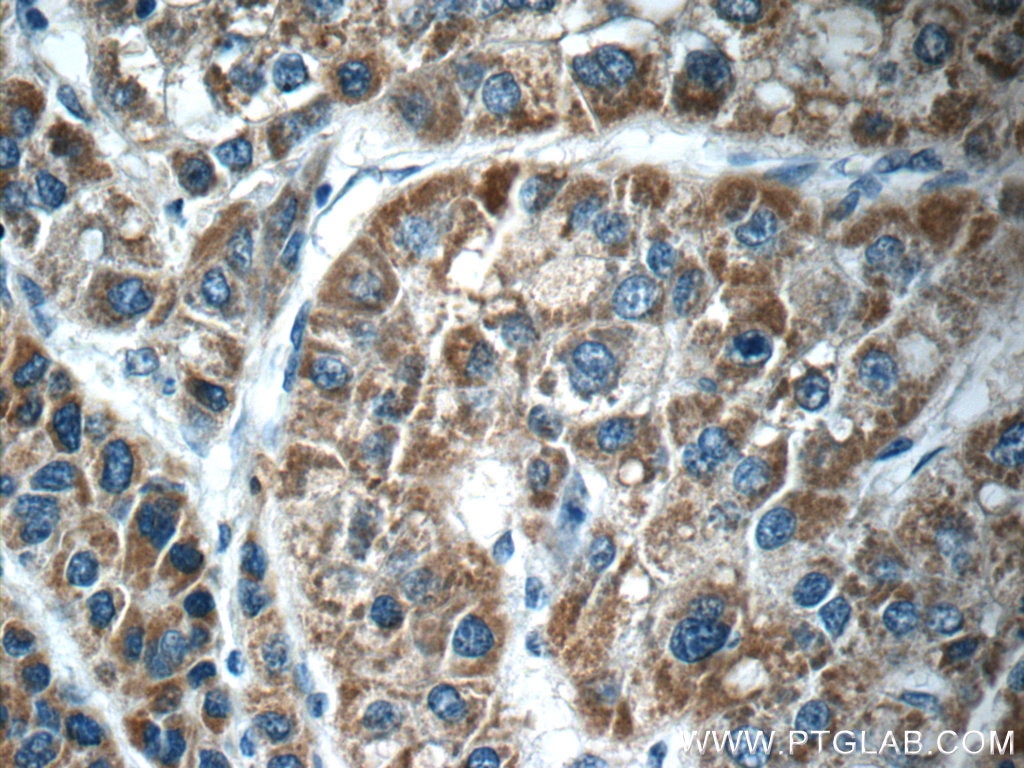 IHC staining of human liver cancer using 15659-1-AP