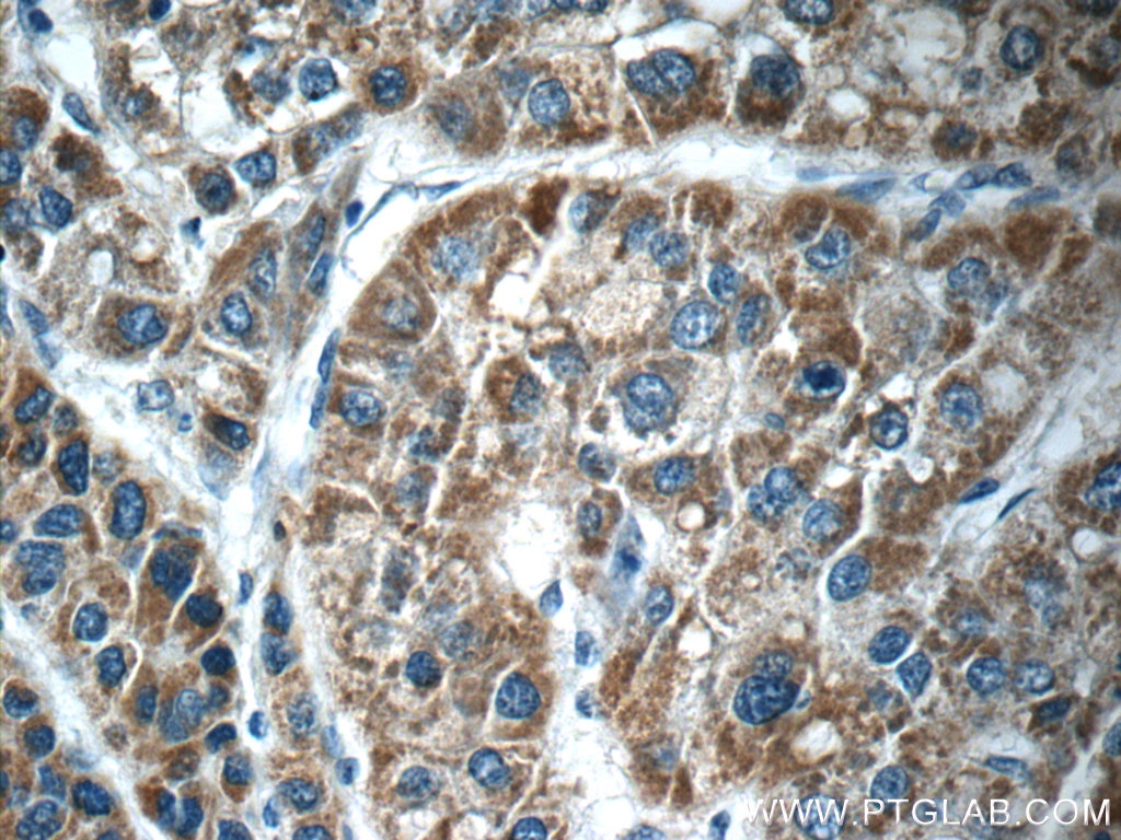 Immunohistochemistry (IHC) staining of human liver cancer tissue using PIWIL1 Polyclonal antibody (15659-1-AP)