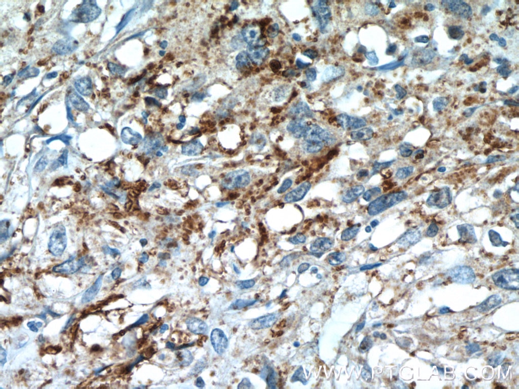Immunohistochemistry (IHC) staining of human cervical cancer tissue using PIWIL2 Polyclonal antibody (14209-1-AP)