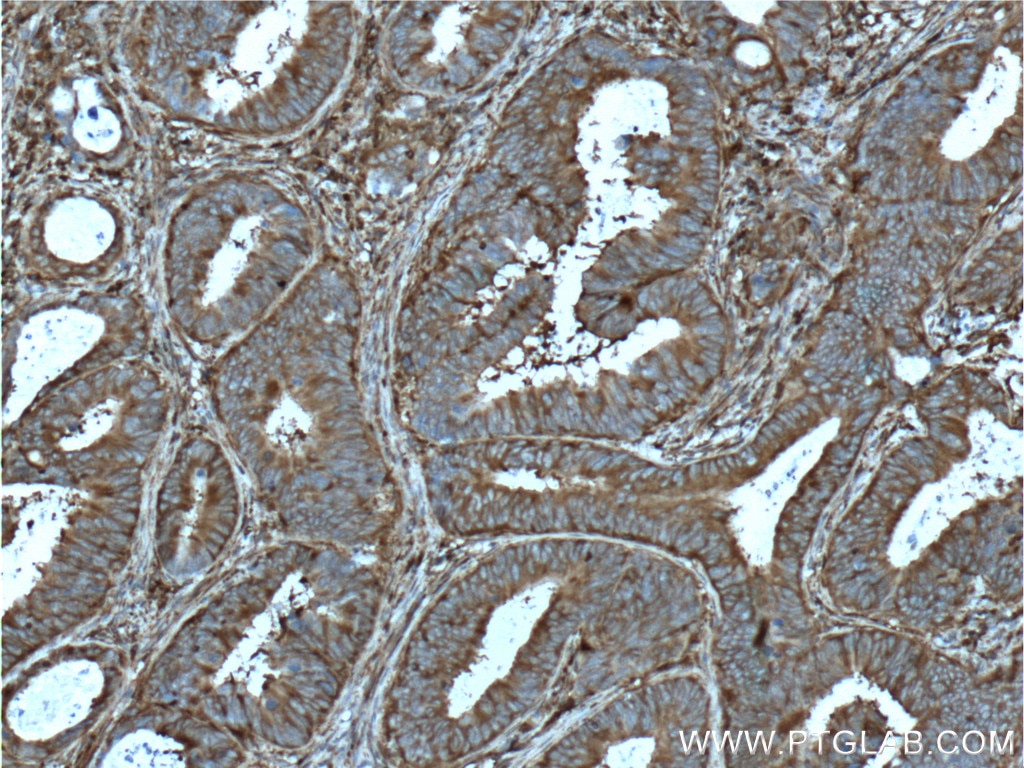 Immunohistochemistry (IHC) staining of human colon cancer tissue using PKM2-specific Monoclonal antibody (60268-1-Ig)