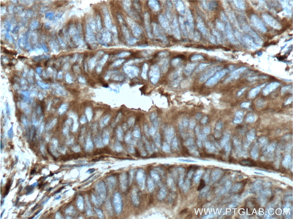 Immunohistochemistry (IHC) staining of human colon cancer tissue using PKM2-specific Monoclonal antibody (60268-1-Ig)