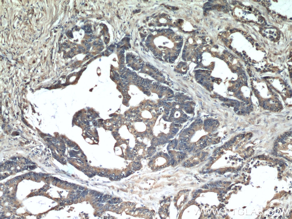Immunohistochemistry (IHC) staining of human colon cancer tissue using PKM2-specific Monoclonal antibody (60268-1-Ig)