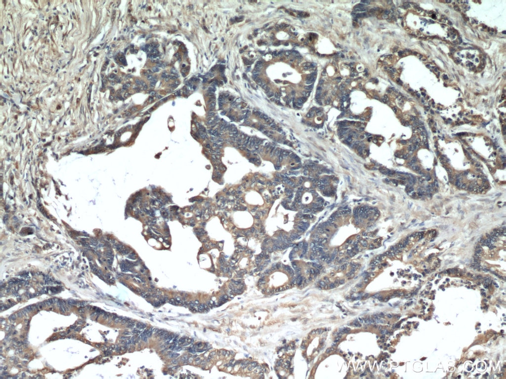 IHC staining of human colon cancer using 60268-1-Ig