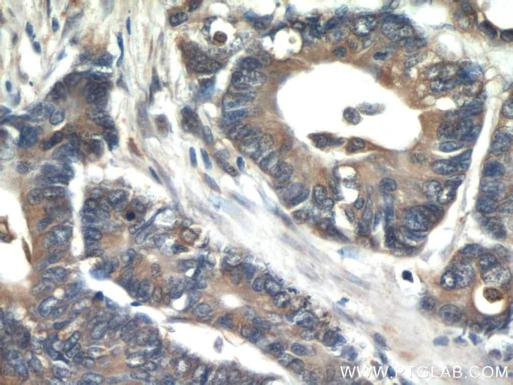 Immunohistochemistry (IHC) staining of human colon cancer tissue using PKM2-specific Monoclonal antibody (60268-1-Ig)