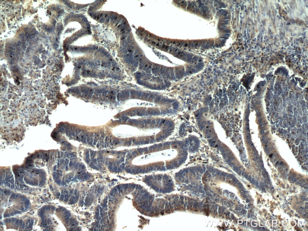 IHC staining of human colon cancer using 60268-1-Ig