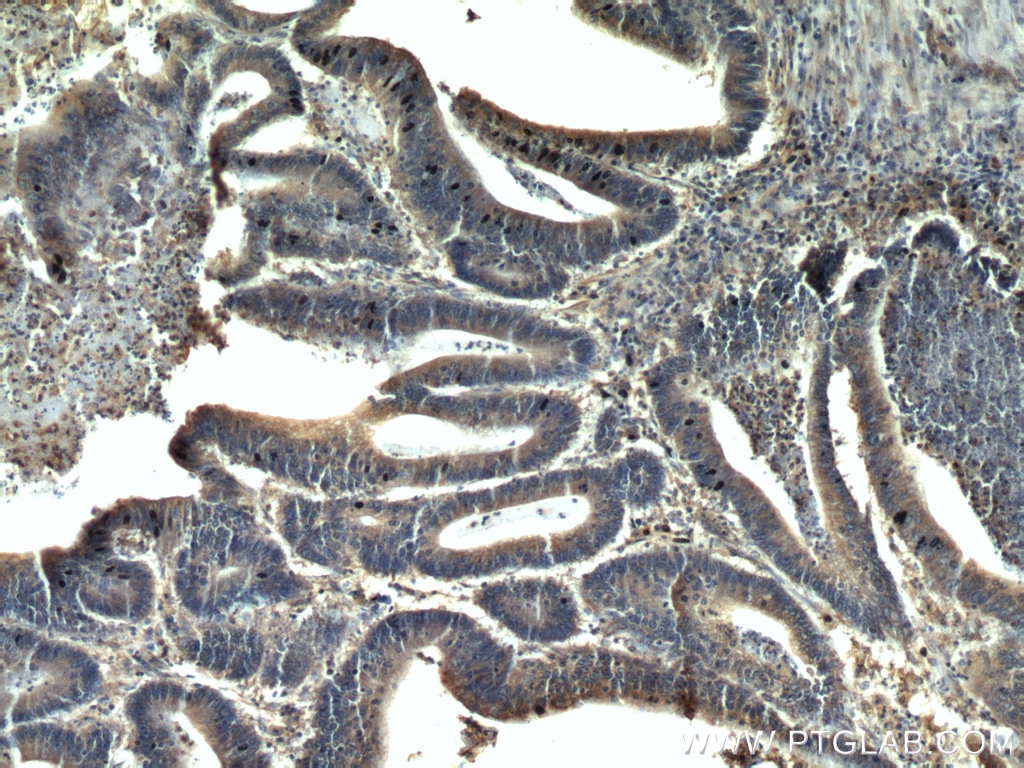 Immunohistochemistry (IHC) staining of human colon cancer tissue using PKM2-specific Monoclonal antibody (60268-1-Ig)