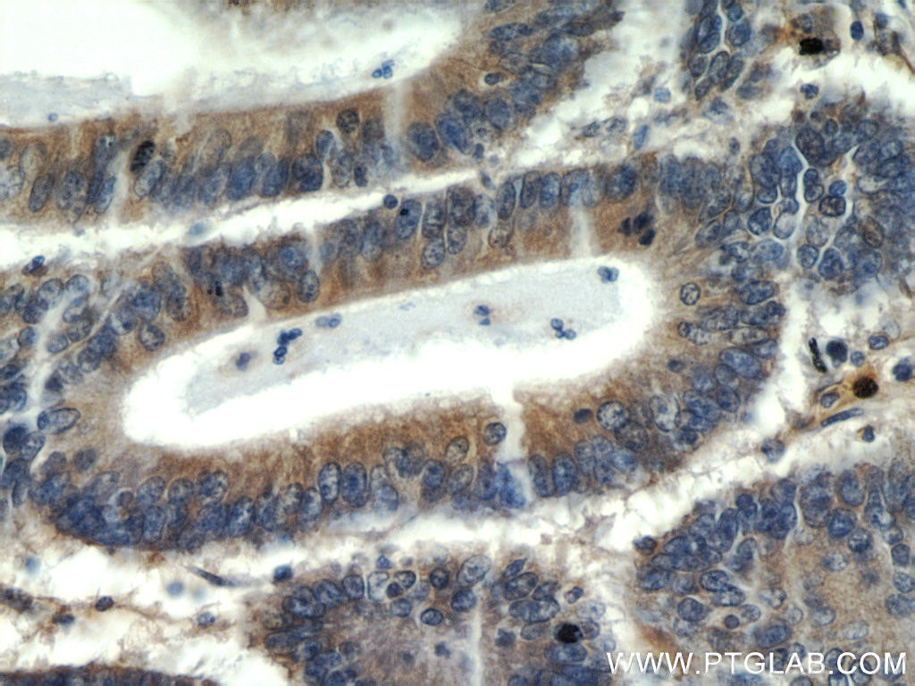 Immunohistochemistry (IHC) staining of human colon cancer tissue using PKM2-specific Monoclonal antibody (60268-1-Ig)